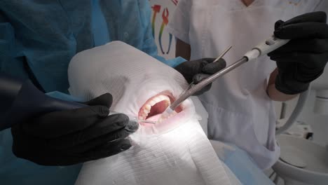 procedimiento de blanqueo de dientes. gel blanqueador de dientes. el dentista hace el procedimiento de blankeo