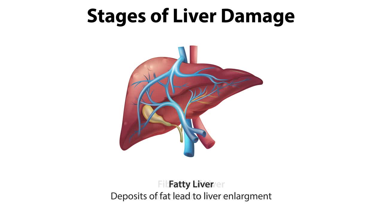 Visual progression of liver damage stages