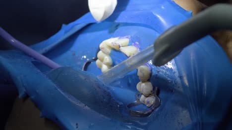 showering and suctioning residues after removing tartar during dental hygiene