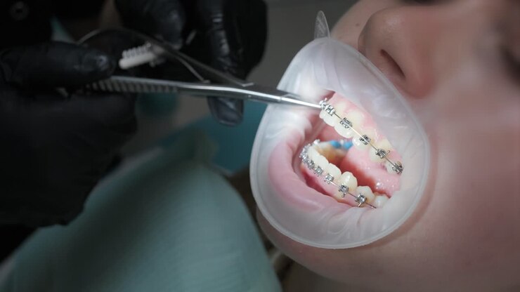 Close up of dentist hand using dental forceps while putting orthodontic braces on female patient teeth. Woman having dental procedure in clinic. Concept of dentistry and orthodontic treatment.