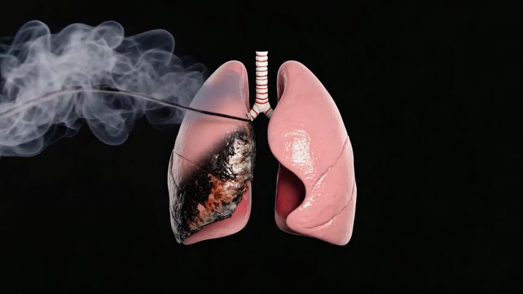 Smoking's Impact on Lung Health