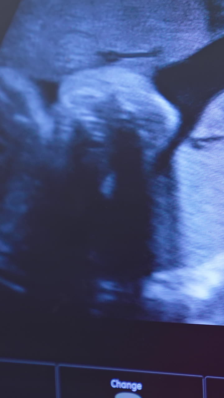 Immagine ecografica dinamica di un embrione sullo schermo. Il piccolo bambino si gira nella pancia della madre. Il bambino nel grembo materno si muove durante l'ecografia. Primo piano. Video verticale