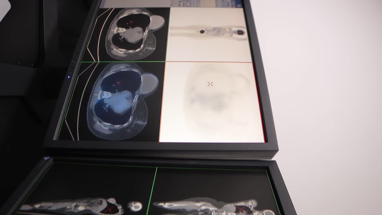 클리닉의 전문실에서 신체의 여러 부위에 종양이 있는 환자를 스캔하는 pet-ct라는 기계로 스캔한 환자의 정보를 표시하는 모니터