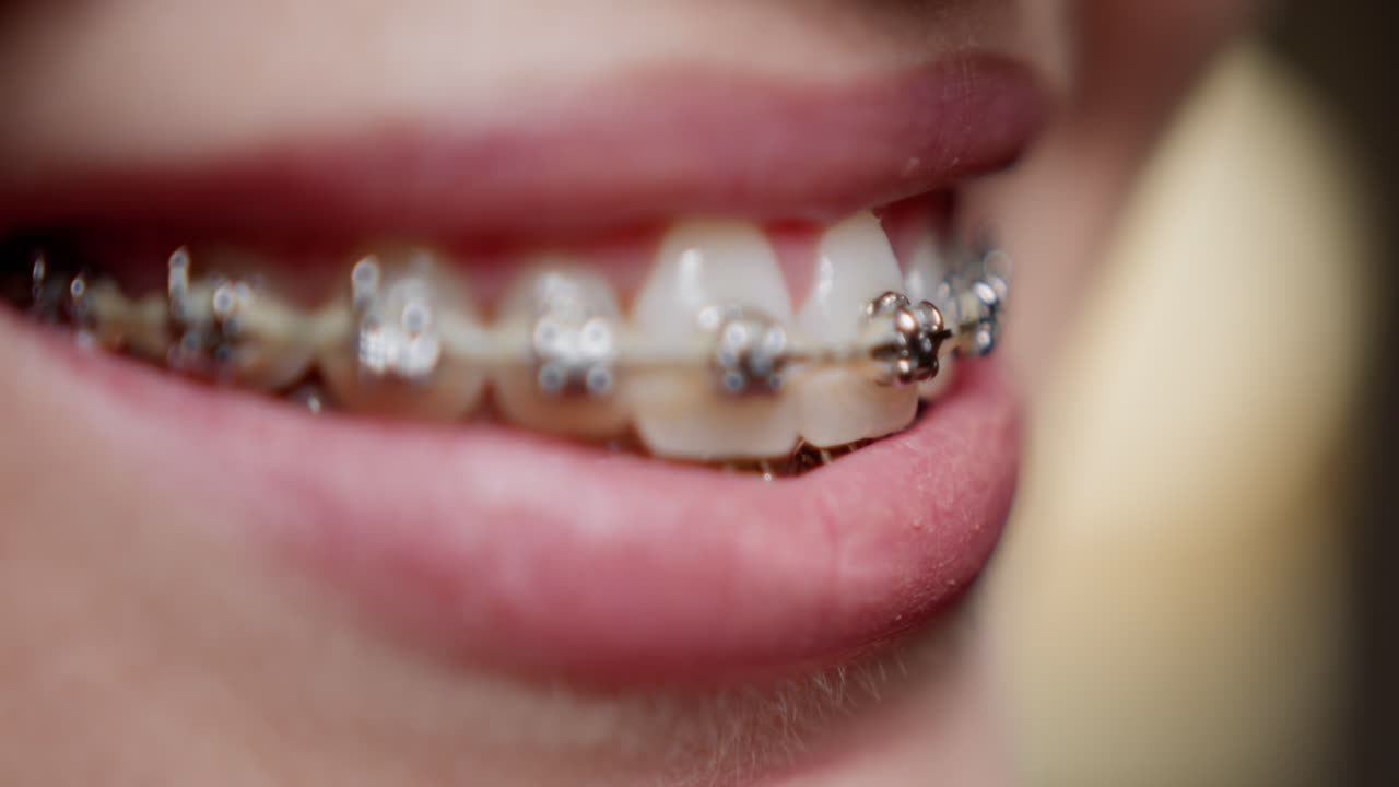 Close-up of teeth with braces