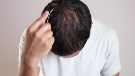 young man using derma roller on head for stimulating new hair growth, microneedling treatment for androgenic alopecia