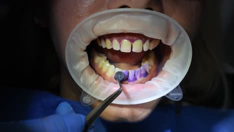 Orthodontist-Spreads-Dental-Plaque-Disclosing-Agent-On-Female-Patient's-Teeth-Close-Up-Mouth-Guard