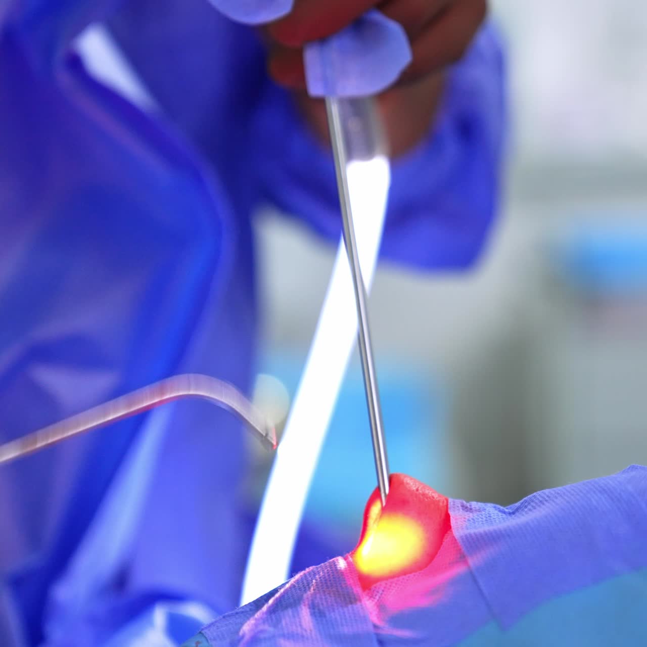 Hands of a surgeon hold the flashlight in the nasal cavity of a patient. Doctor shoves the metal instrument into the nose to perform rhinoplasty. Close up