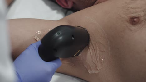 underarm laser procedure for hair removal on a man - close up