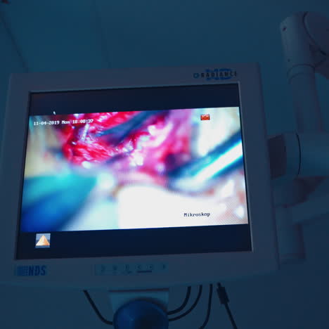 surgery on the monitor. neurosurgical process displayed on a screen. modern equipment in the operating room. healthcare concept.