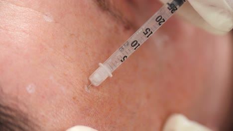botox injection by a beautician with a syringe into a man's forehead. close up.