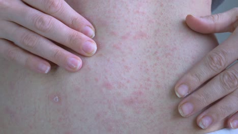 hands show the affected areas of the skin on the abdominal cavity. on the areas of the rash in red. a centimeter from the navel is a skin rash with a scab. viral diseases. close-up