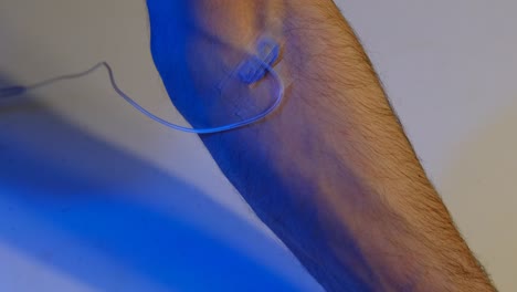 brazo de acceso vascular