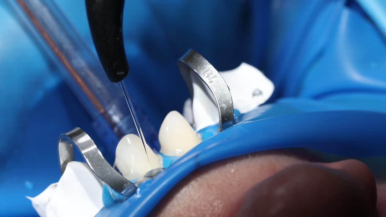 Close-up of a dental procedure with a rubber dam