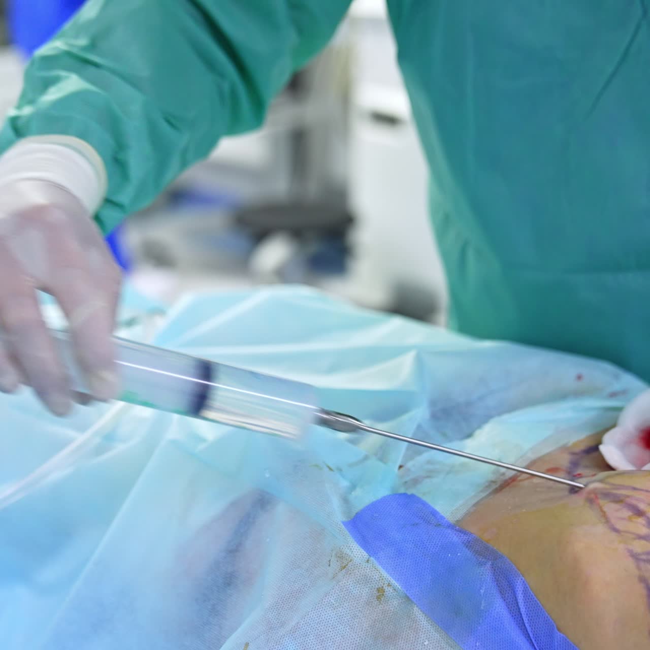 Doctor moving quickly with a huge syringe inputting medicines into patient's belly. Liposuction operation in modern clinic of plastic surgery