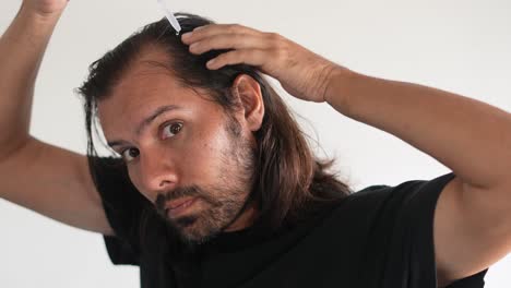 man applying minoxidil to hair with dropper, baldness, hair density