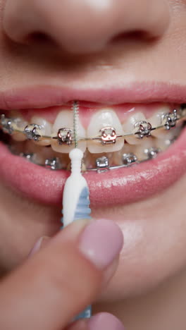Cleaning Braces with an Interdental Brush