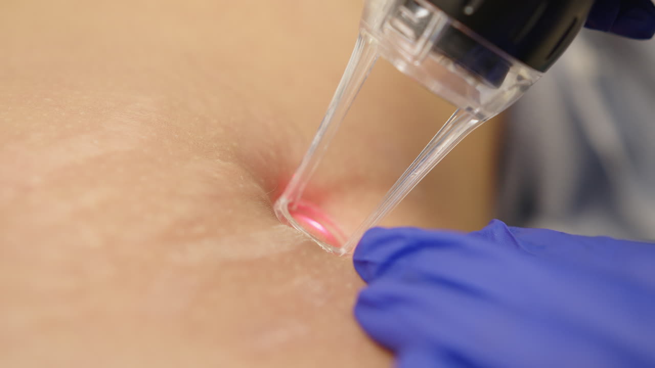 procedimiento médico estético en el cuerpo humano