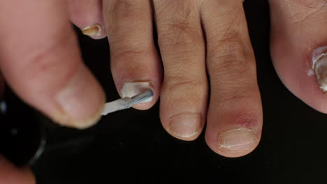 anti-fungal treatment applied to the fourth toe, spreading white paste on a partially infected nail