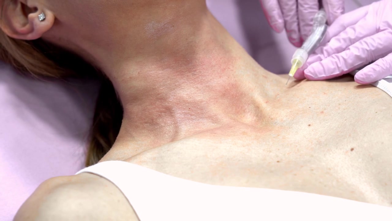 Medico che somministra un'iniezione di terapia con anidride carbonica o carbossiterapia al suo paziente in un.