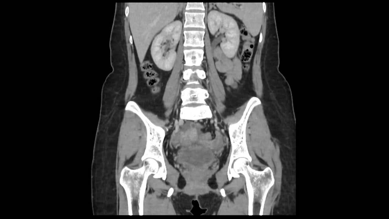 CT scan uncovers appendicitis and gallstones aiding diagnosis in a radiology department setting.