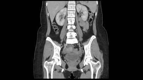 ct scan uncovers appendicitis and gallstones aiding diagnosis in a radiology department setting.
