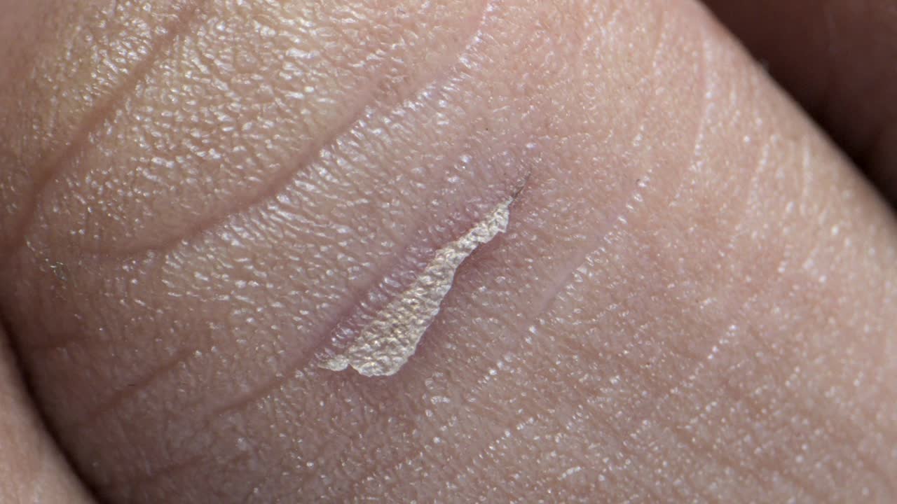 인간의 손가락에 건조하게 은 상처 극단적인 근접