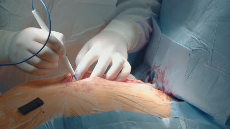 surgeon cuts inner body tissues with laser scalpel closeup. skilled cardiologist uses high precision instrument for coronary artery bypass surgery