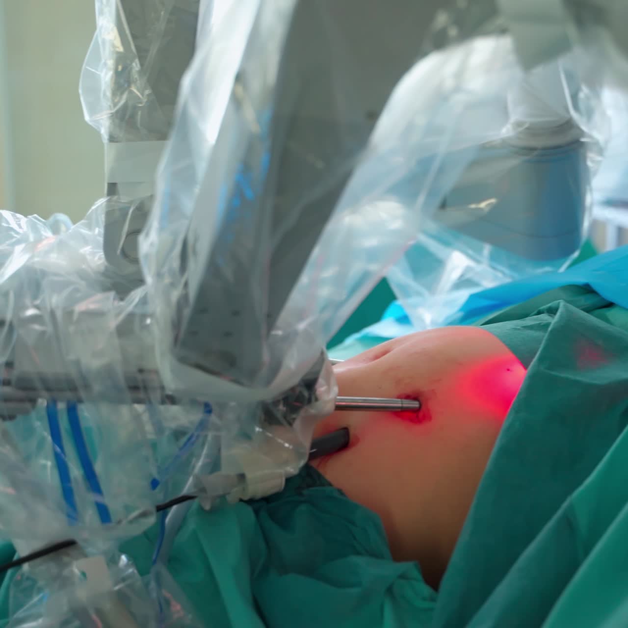 Minimally invasive surgery in clinic. Modern technology in surgery. Surgical robot in patient's abdomen. Robotic arms performing for cancer removal surgery