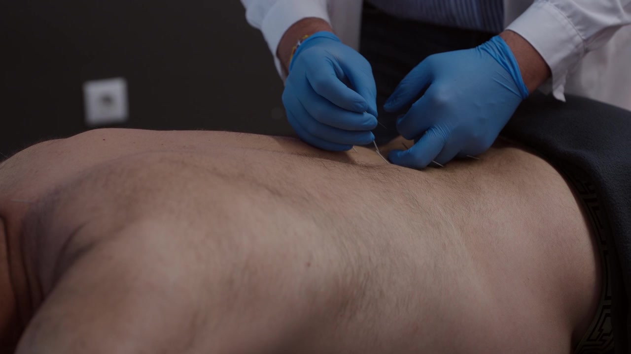 Un primo piano di un terapista con guanti blu che esegue agopuntura sulla schiena di un uomo. Scena autentica di benessere e medicina alternativa per contenuti su assistenza sanitaria e guarigione olistica.