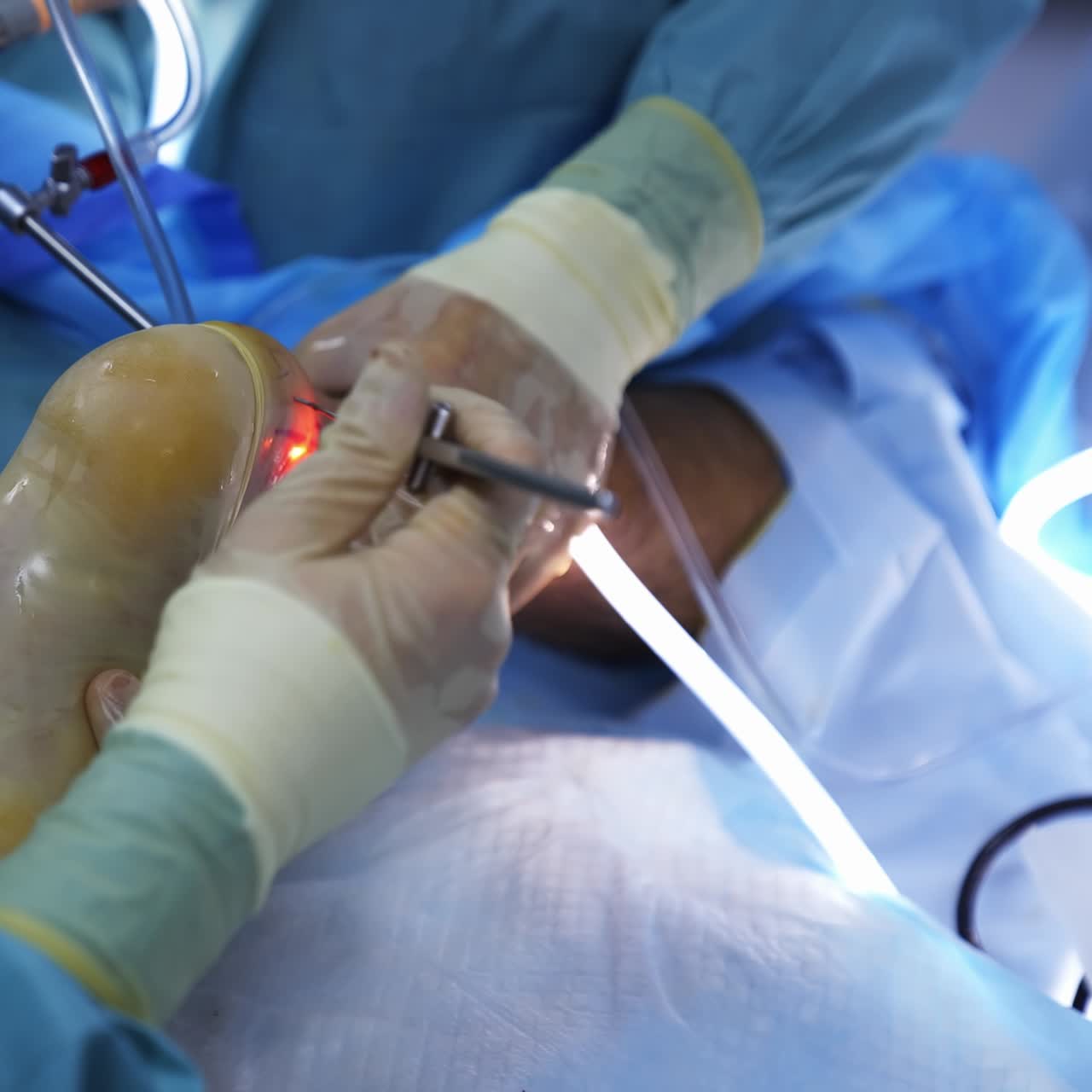 Group of surgeons in operating room with surgery equipment. Process of trauma surgery operation