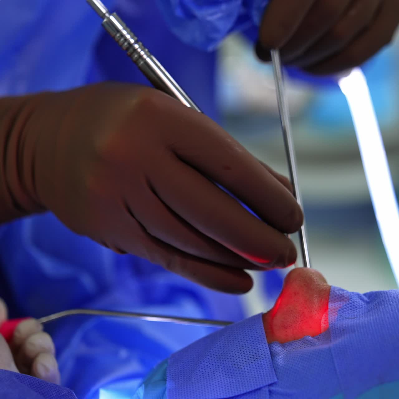 Instruments used in the nose of a patient. Rhinoplasty operation in process. Close up. Blurred backdrop