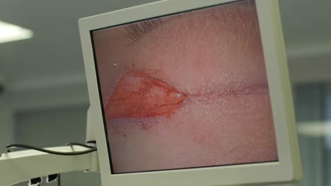 blefaroplastia cirugía plástica operación de rejuvenecimiento, modificación de la región del ojo
