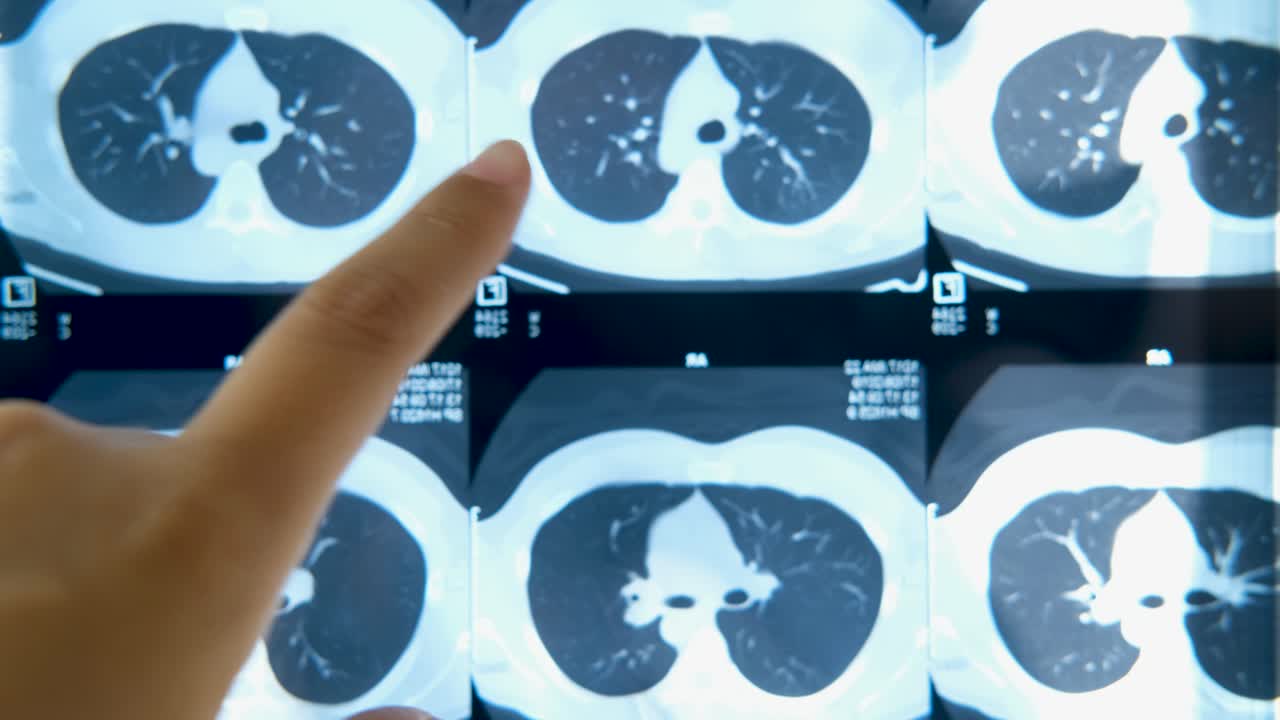 female doctor examing chest ct scan, lung desease x ray tomography.