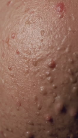 close-up view of skin with acne