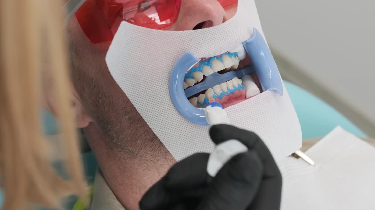 Teeth whitening procedure. Tooth whitening gel. Dentist does the whitening procedure