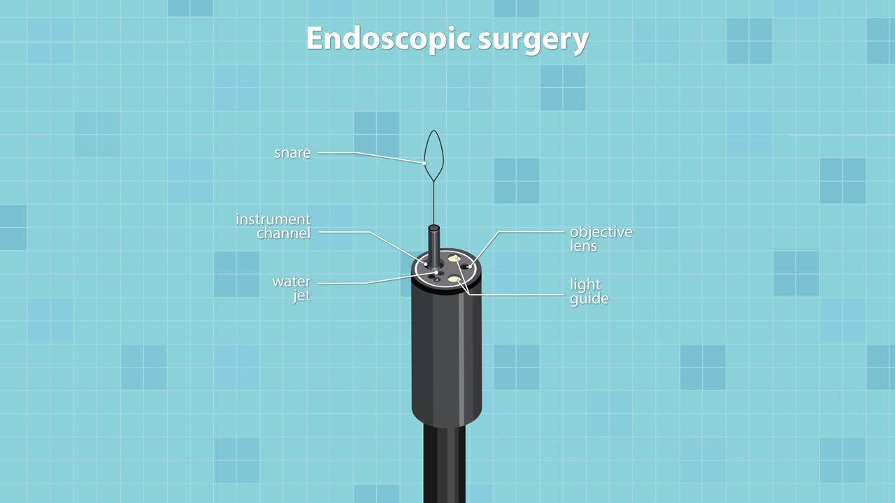 Medical animation illustrating endoscopic surgery procedure within the digestive tract, highlighting tool movement and anatomy