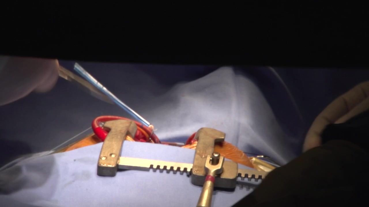 Primo piano di un divaricatore sternale in metallo pesante che tiene aperta la sede dell'incisione durante una complessa procedura chirurgica, con le mani in silhouette di un chirurgo che lavora sotto le luci della sala operatoria