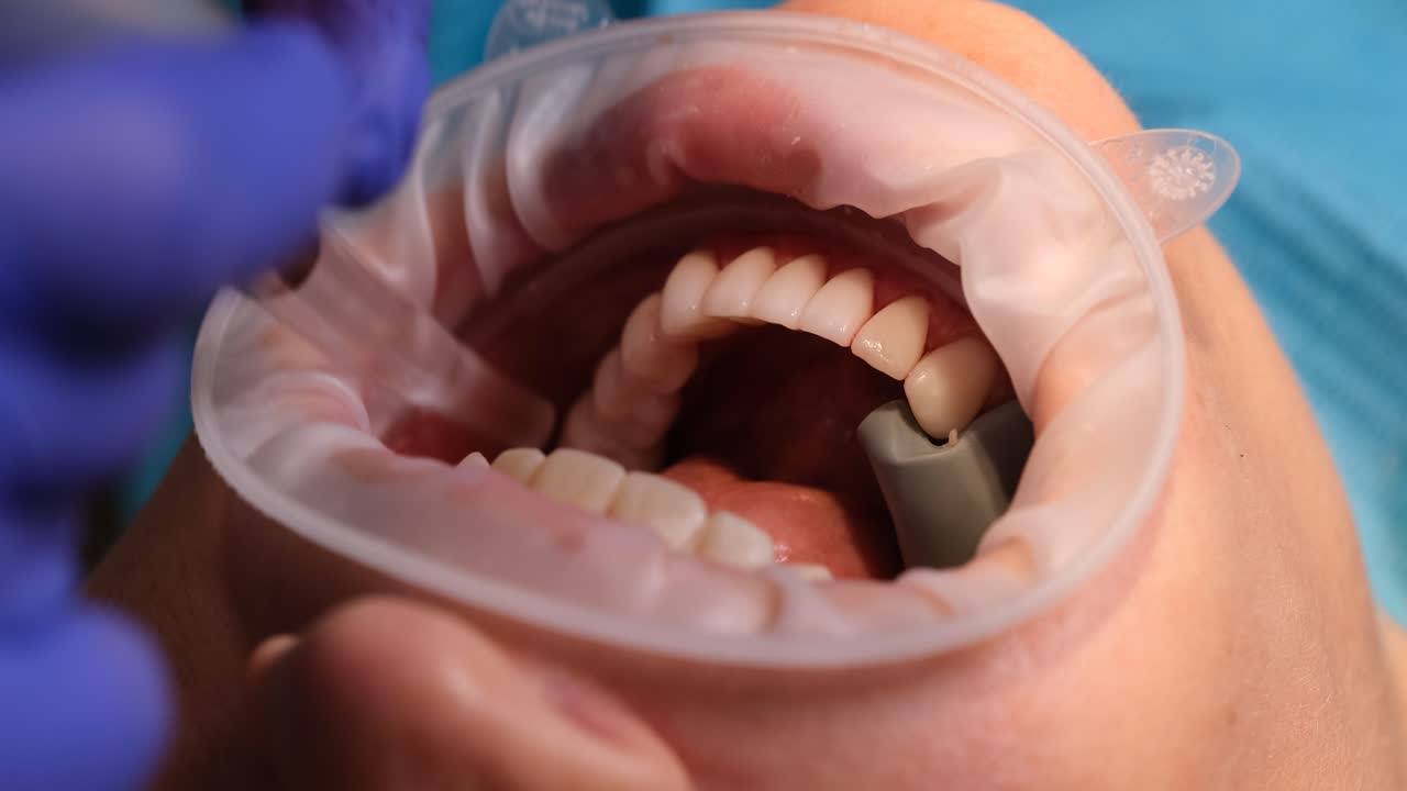 Dental Procedure with Curing Light and Mouth Retractor