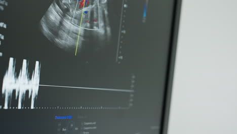 close up of x-ray machine screen displaying detailed sound wave readings during diagnostic imaging session with clear visualization of internal body structure and frequency data for medical analysis