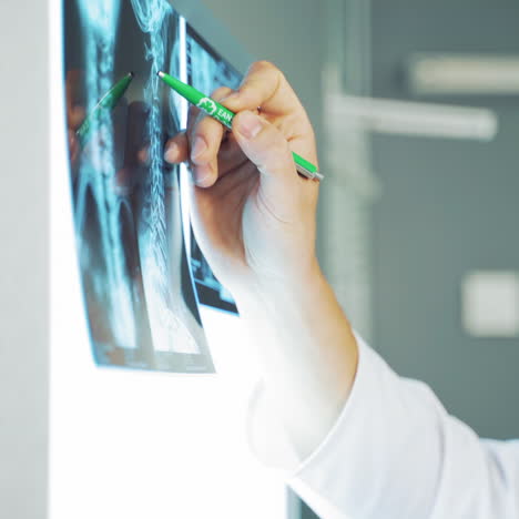 male doctor is showing with a pen the problem area on the x-ray photography. close-up of spinal tomography on the white screen.