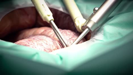 surgical experts demonstrate advanced techniques in a medical operating room, highlighting key instruments and careful procedures during a delicate operation.