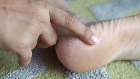 dry and cracked heels: a close-up view