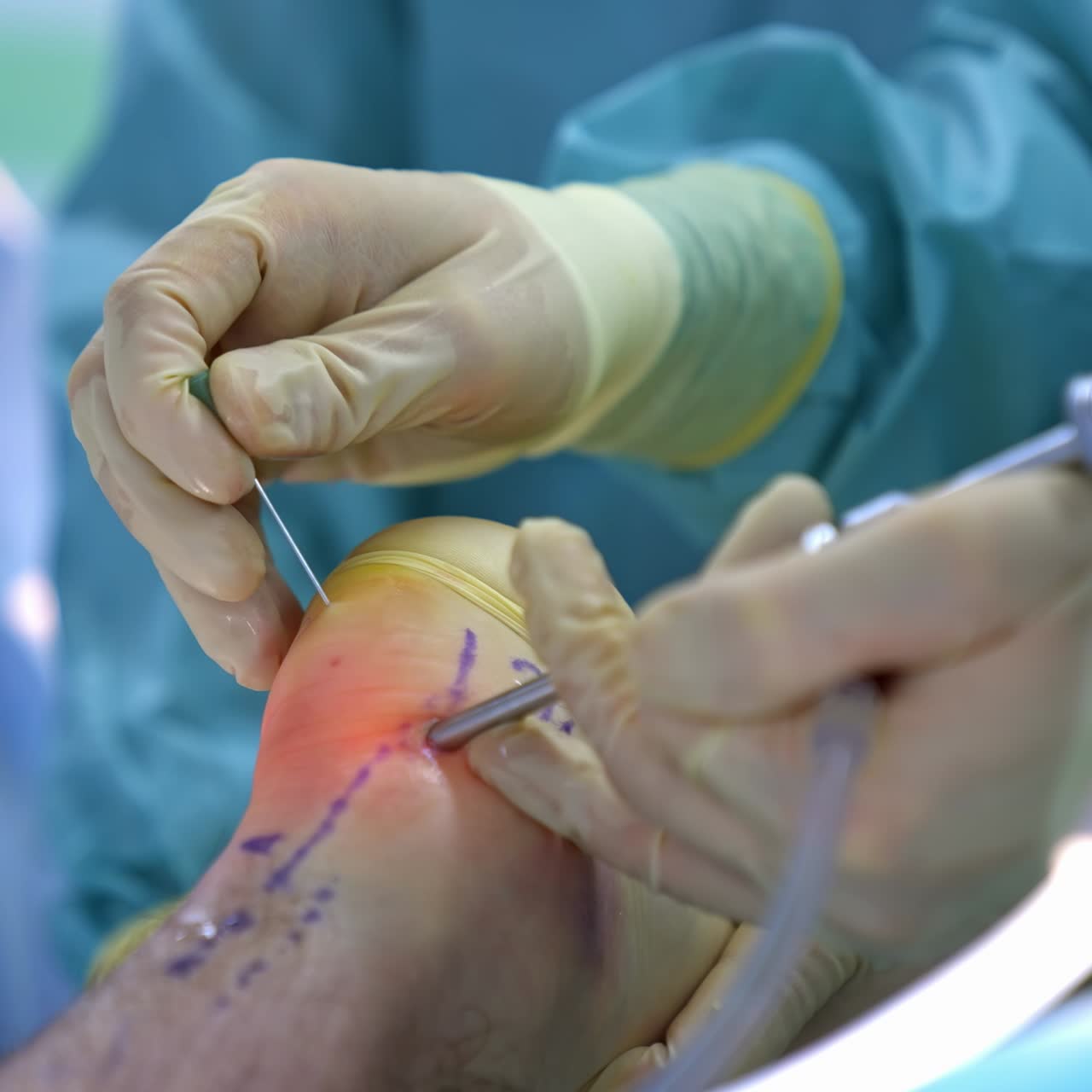 Medical team performing operation. Group of surgeon at work in operating theatre
