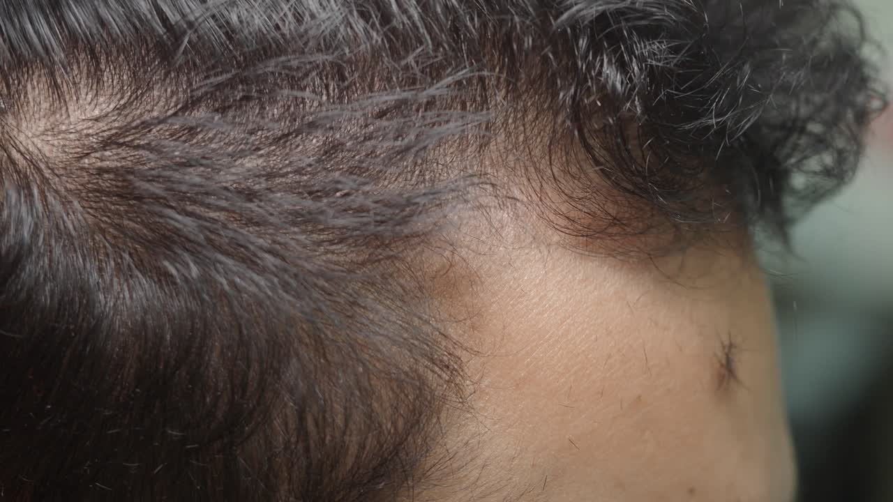 Hair Loss on Head
