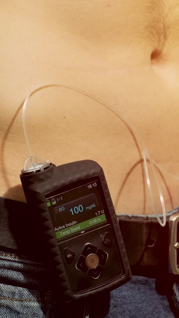 Närbild på en person som sätter på insulinpump för diabeteshantering
