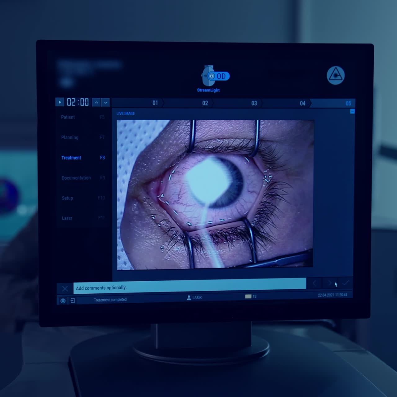 Computer monitor with eye surgery getting shown. Eye getting wiped while being operated. Eye laser treatment on a screen. Close-up