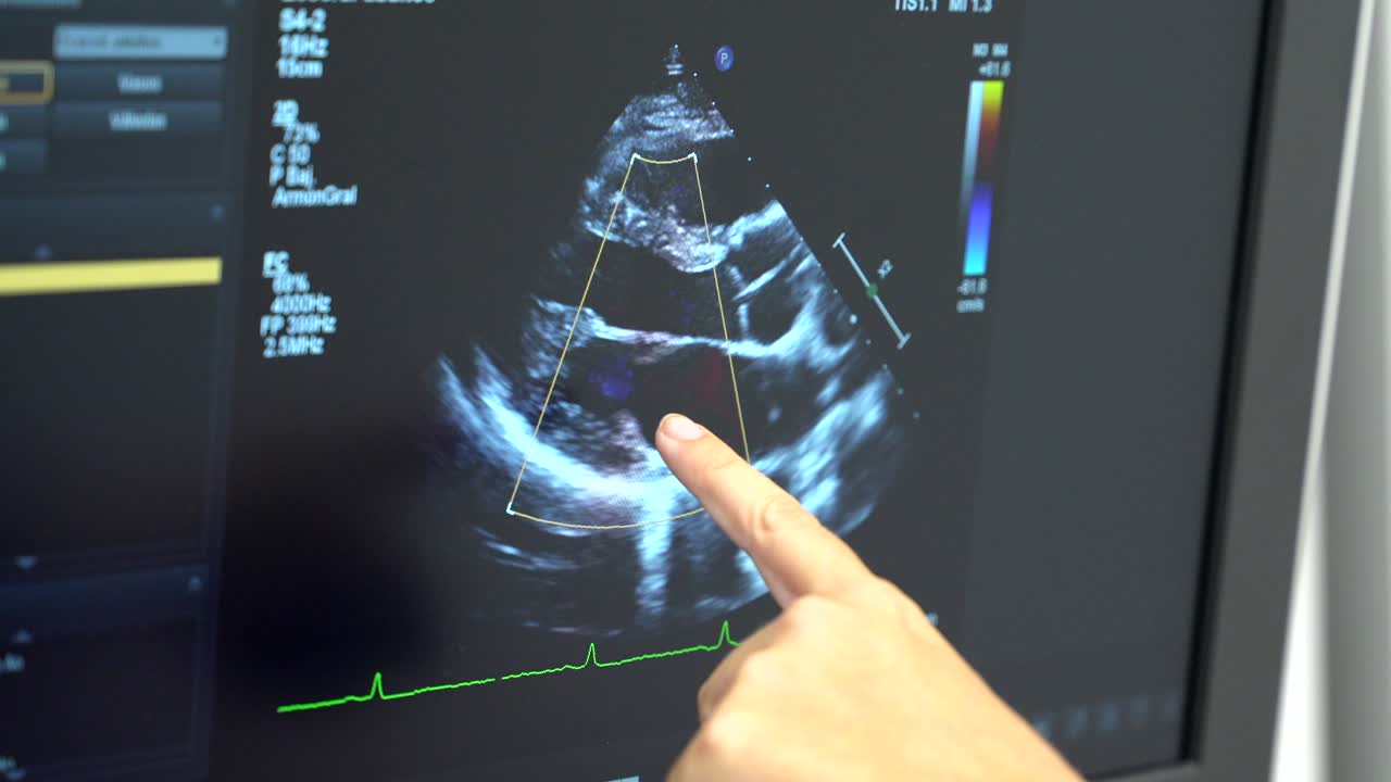 Echocardiogram medical imaging