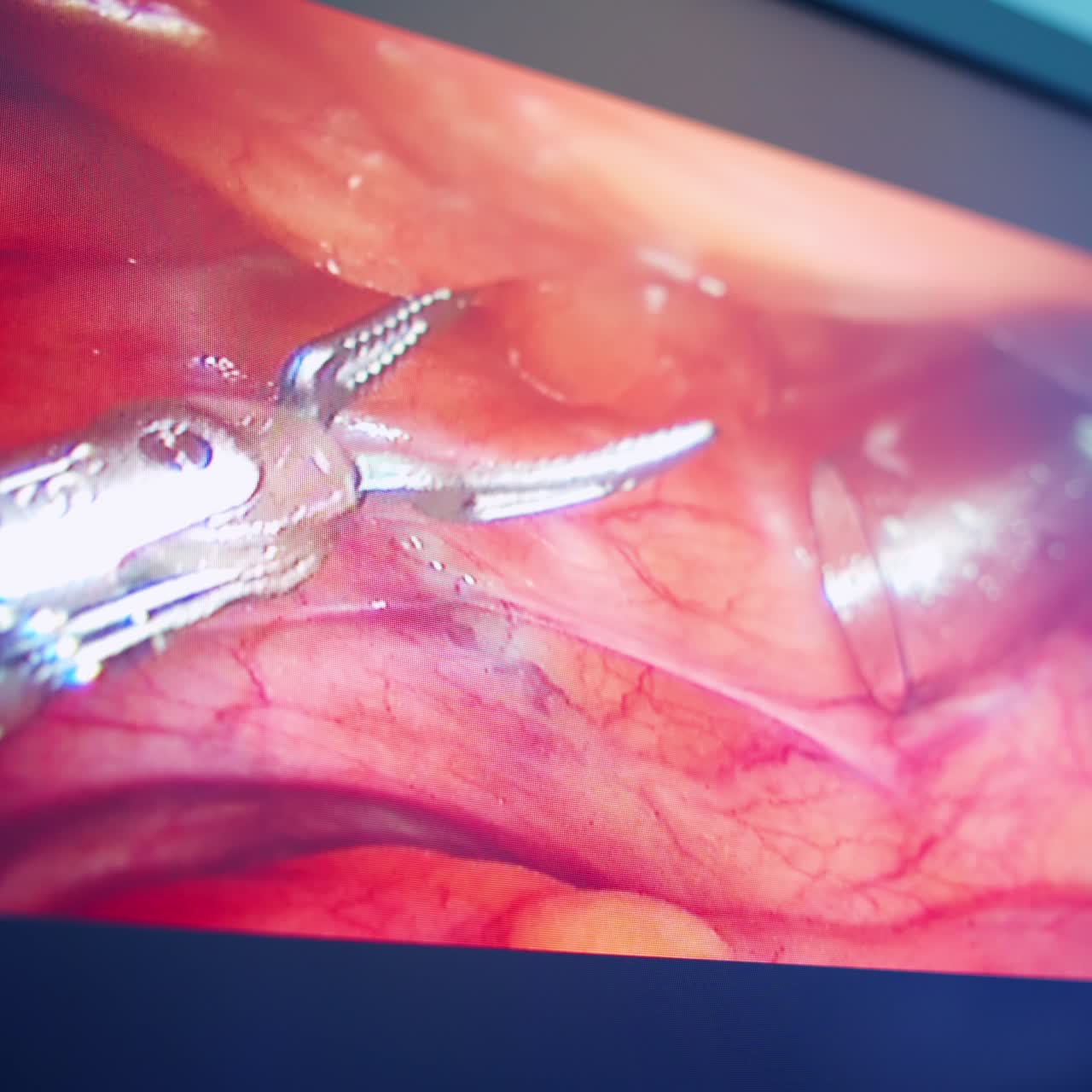Surgery performed by robotic arm