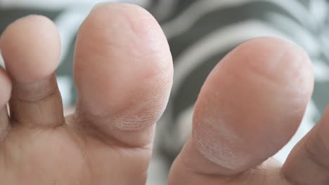 close-up of dry, cracked toes