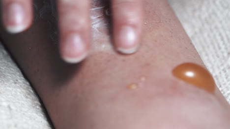 person applies ointment to infected and painful blisters, swollen with fluid and pus discharge